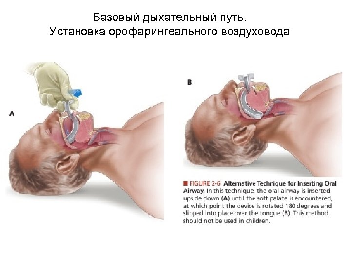 Базовый дыхательный путь. Установка орофарингеального воздуховода 