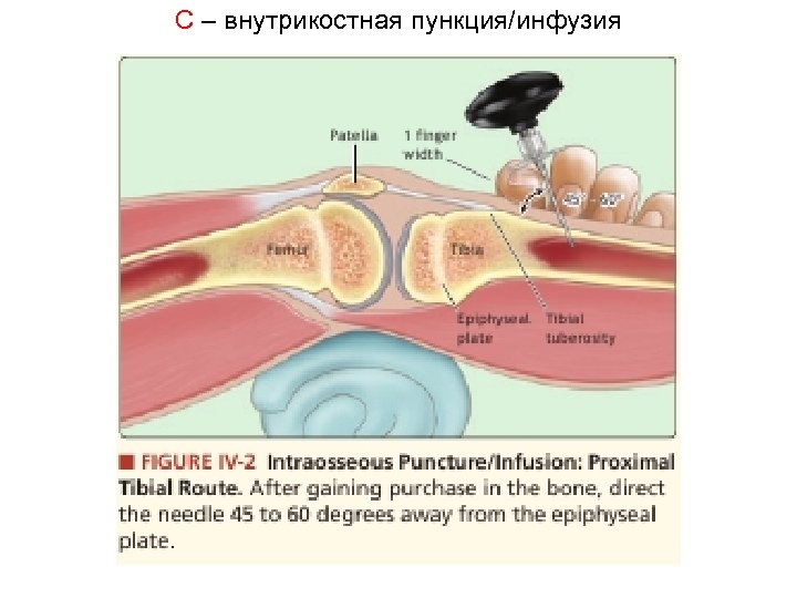 C – внутрикостная пункция/инфузия 