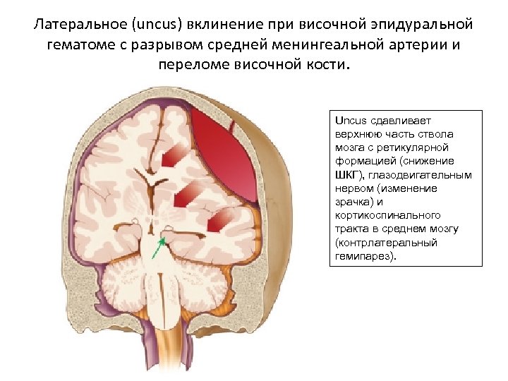 Латеральное (uncus) вклинение при височной эпидуральной гематоме с разрывом средней менингеальной артерии и переломе