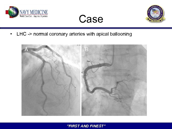 Case • LHC -> normal coronary arteries with apical ballooning ”FIRST AND FINEST” 