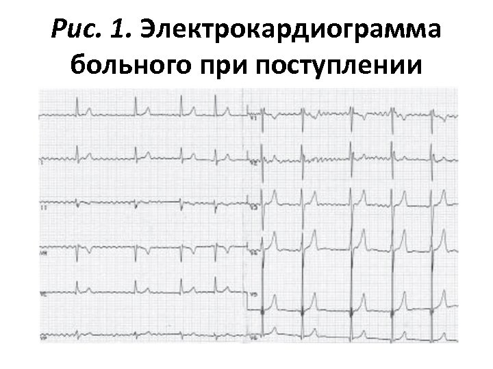 Рис. 1. Электрокардиограмма больного при поступлении 