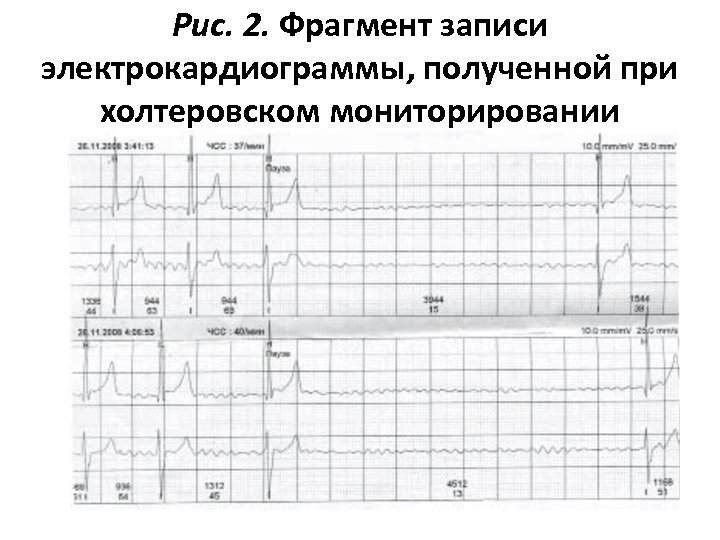Рис. 2. Фрагмент записи электрокардиограммы, полученной при холтеровском мониторировании 