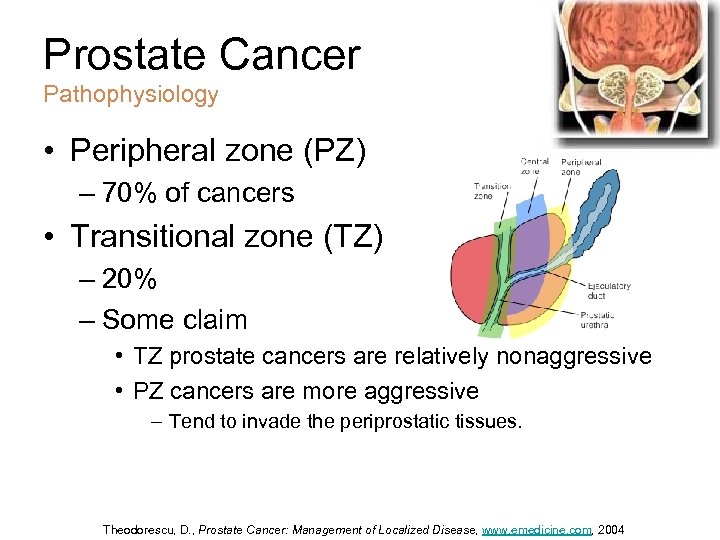 Prostate Cancer Pathophysiology • Peripheral zone (PZ) – 70% of cancers • Transitional zone