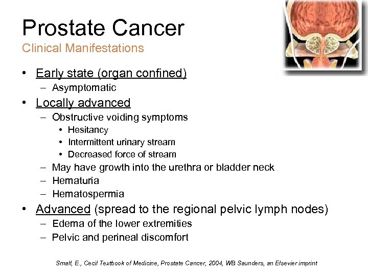 Prostate Cancer Clinical Manifestations • Early state (organ confined) – Asymptomatic • Locally advanced