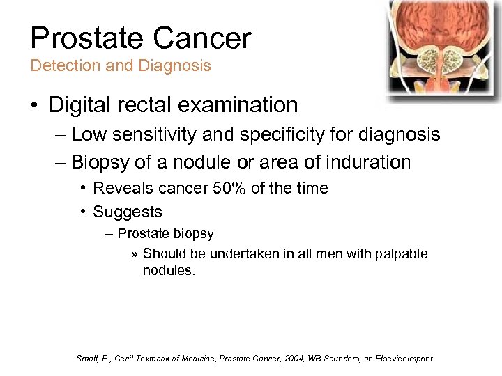 Prostate Cancer Detection and Diagnosis • Digital rectal examination – Low sensitivity and specificity