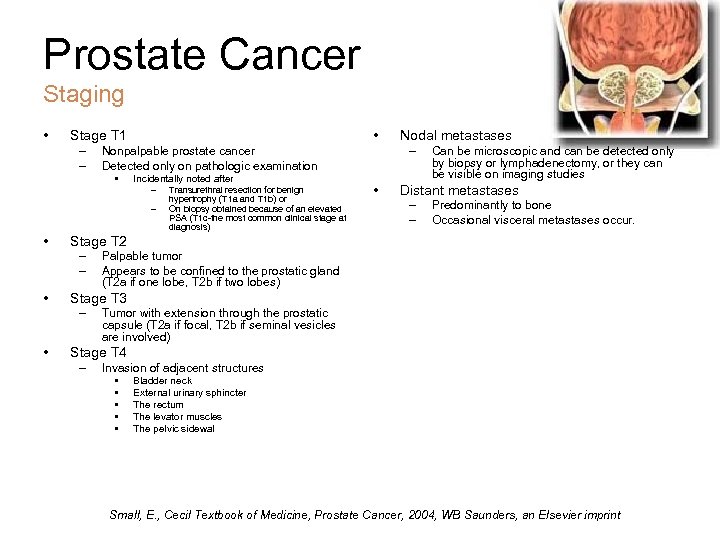 Prostate Cancer Staging • • Stage T 1 – – • Incidentally noted after