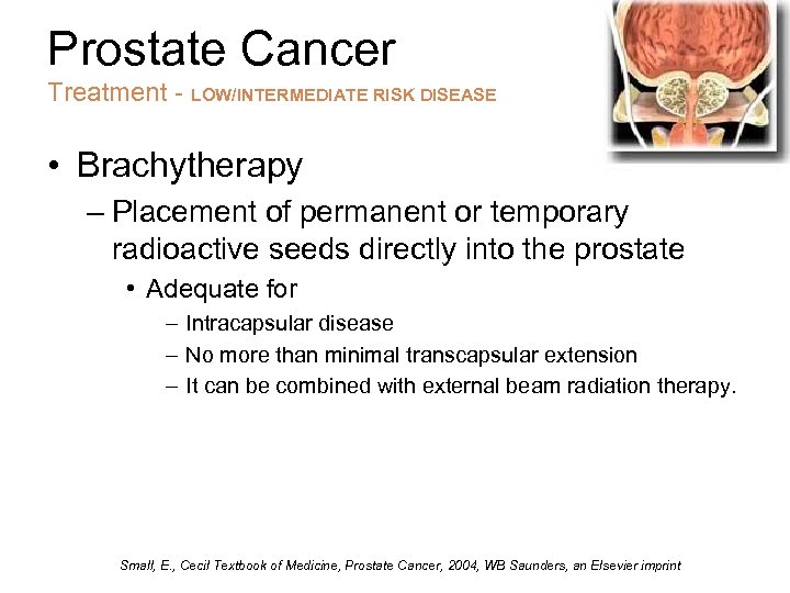 Prostate Cancer Treatment - LOW/INTERMEDIATE RISK DISEASE • Brachytherapy – Placement of permanent or
