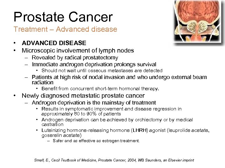 Prostate Cancer Treatment – Advanced disease • ADVANCED DISEASE • Microscopic involvement of lymph
