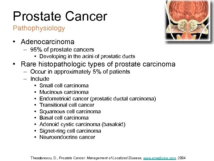 Prostate Cancer Pathophysiology • Adenocarcinoma – 95% of prostate cancers • Developing in the