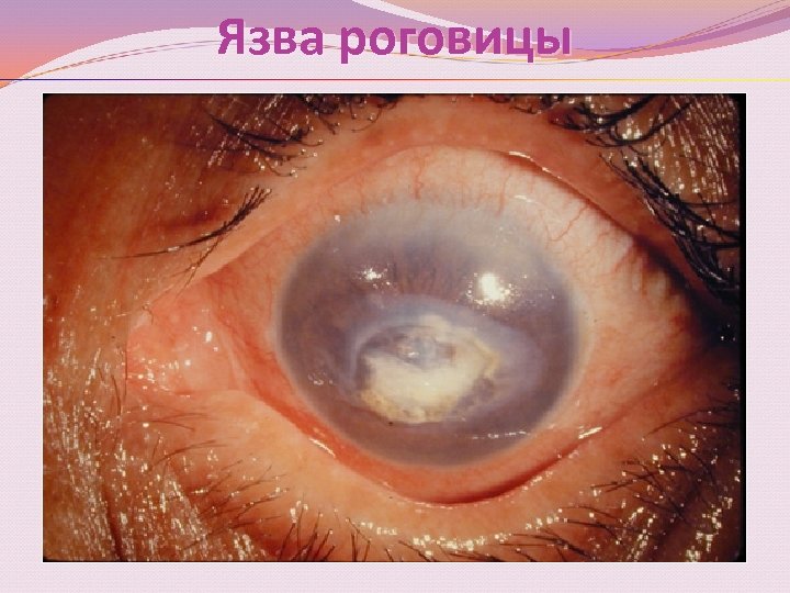 Язва роговицы 
