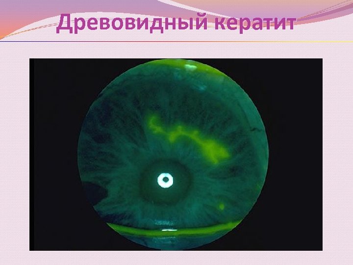 Древовидный кератит 