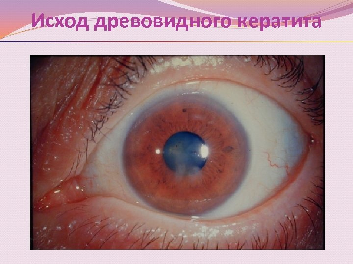 Исход древовидного кератита 