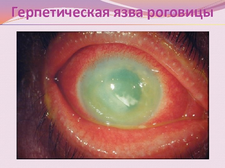 Герпетическая язва роговицы 
