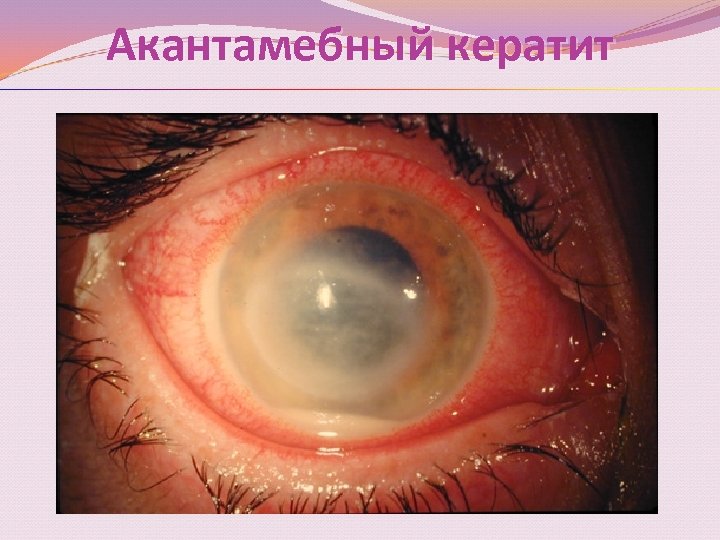 Акантамебный кератит 