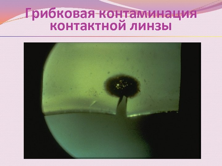Грибковая контаминация Грибковая контактной линзы 