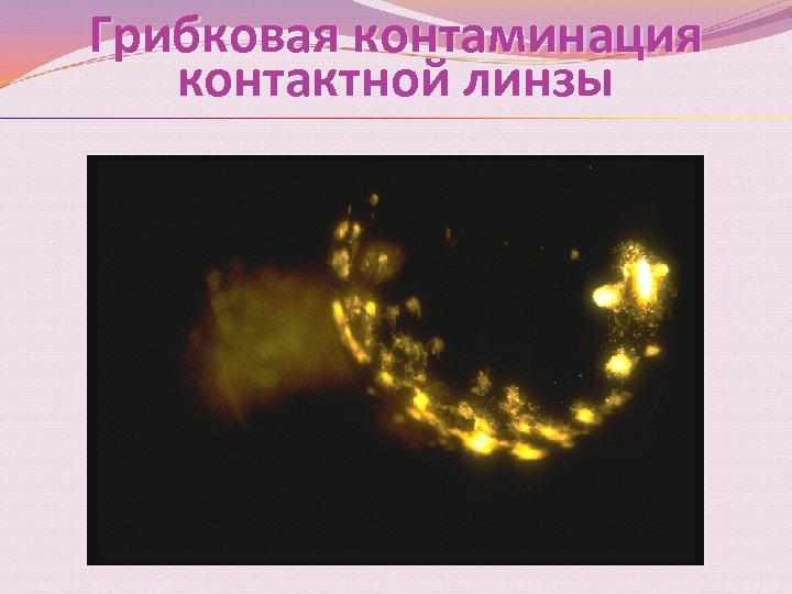 Грибковая контаминация контактной линзы 