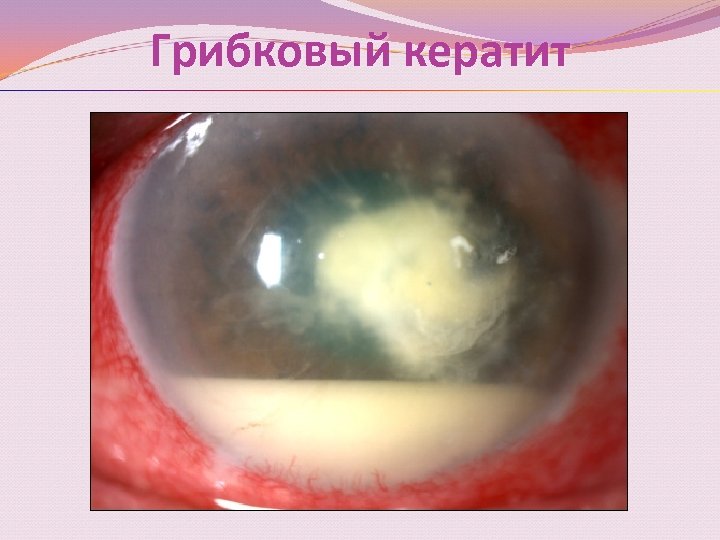 Грибковый кератит 