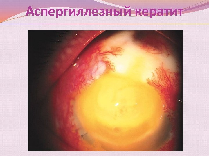 Аспергиллезный кератит 