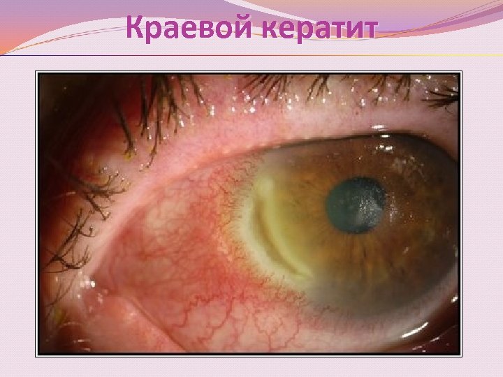 Краевой кератит 