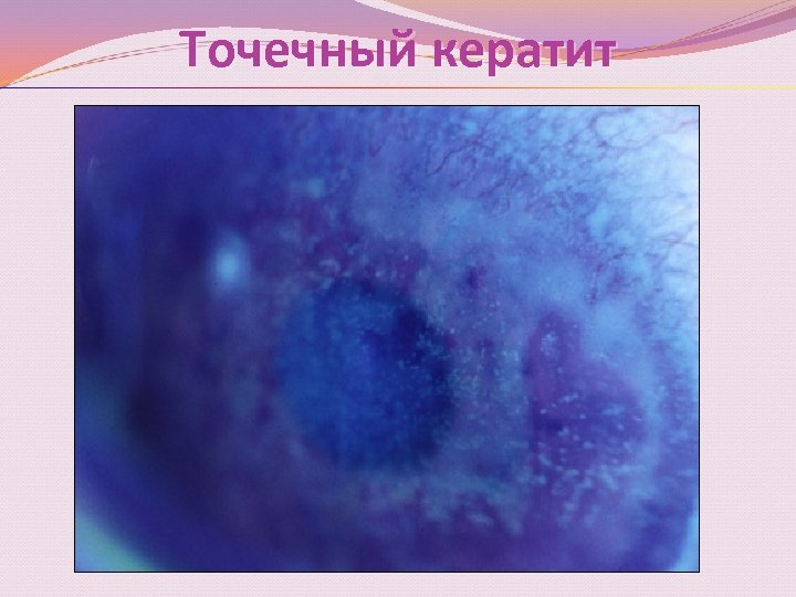 Точечный кератит 