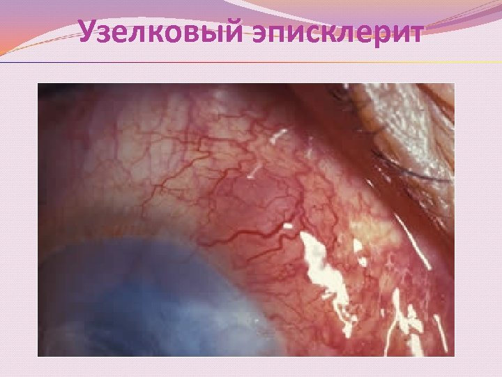 Узелковый эписклерит 