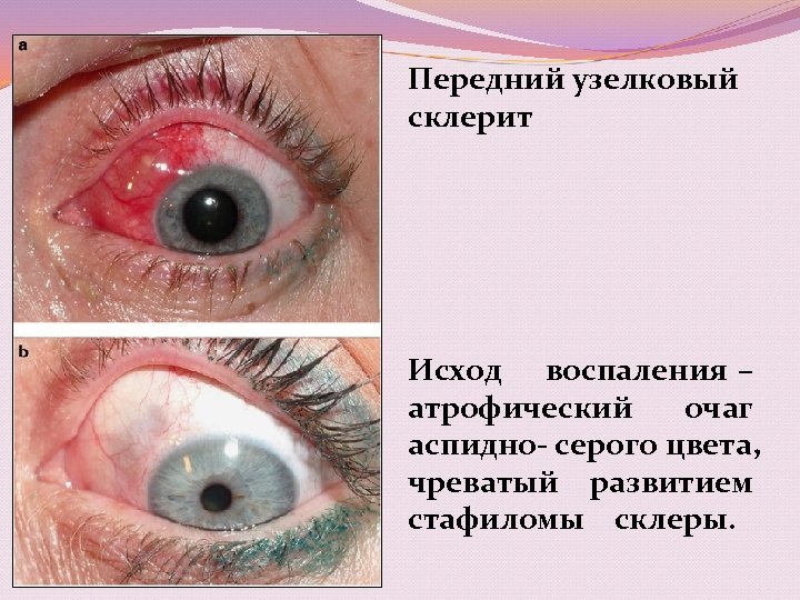 Передний узелковый склерит Исход воспаления – атрофический очаг аспидно- серого цвета, чреватый развитием стафиломы