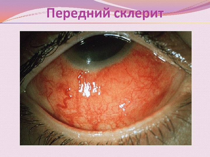 Передний склерит 