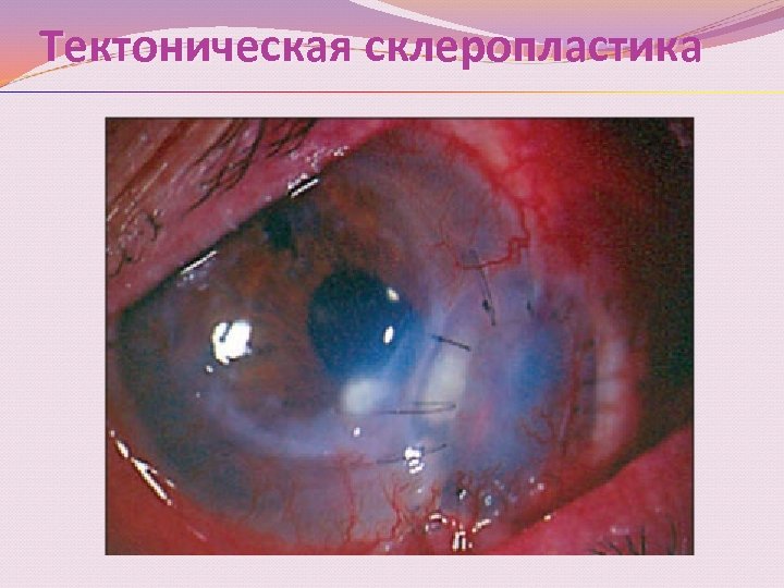 Тектоническая склеропластика 