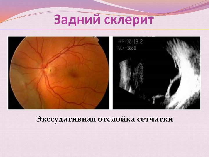 Задний склерит Экссудативная отслойка сетчатки 