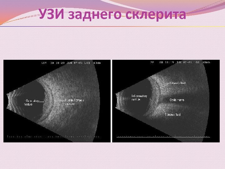 УЗИ заднего склерита 