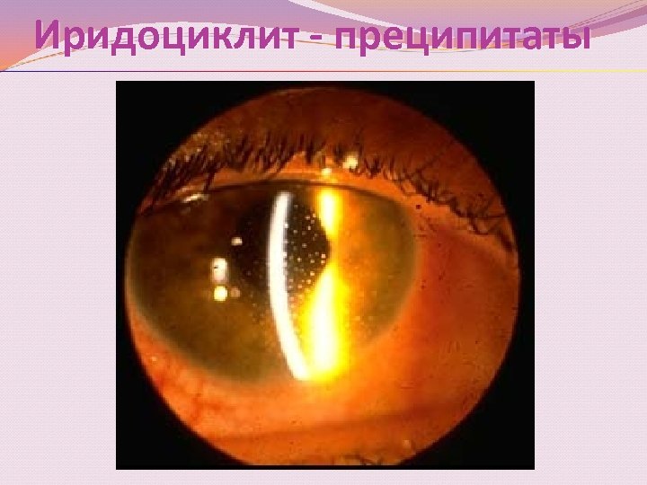 Иридоциклит - преципитаты 