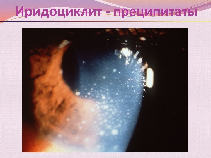Иридоциклит - преципитаты 