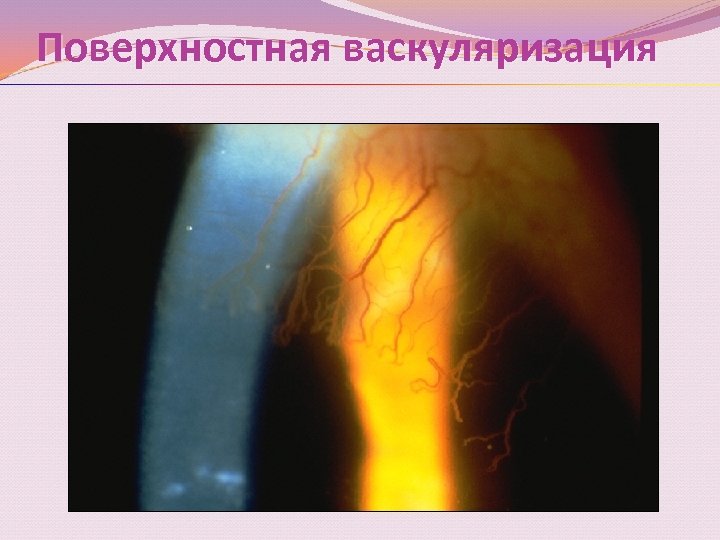 Поверхностная васкуляризация 