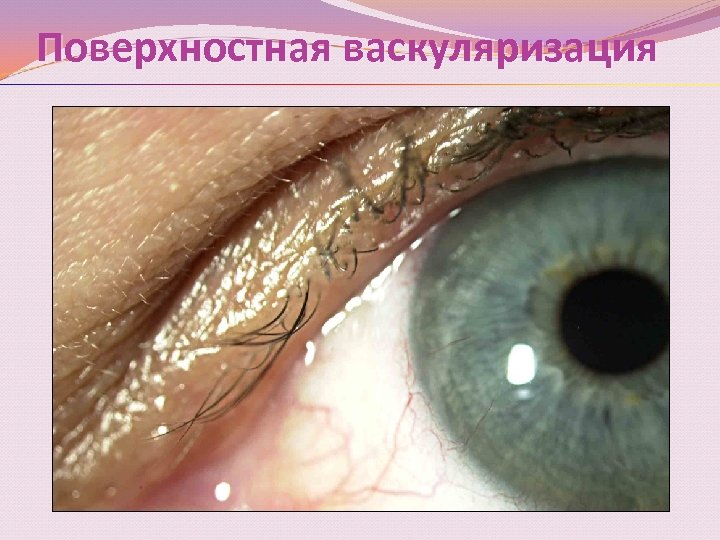 Поверхностная васкуляризация 