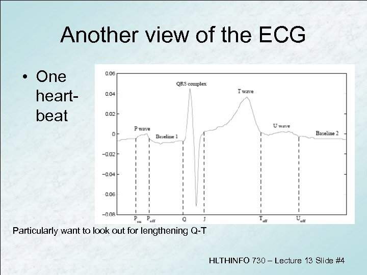 Another view of the ECG • One heartbeat Particularly want to look out for