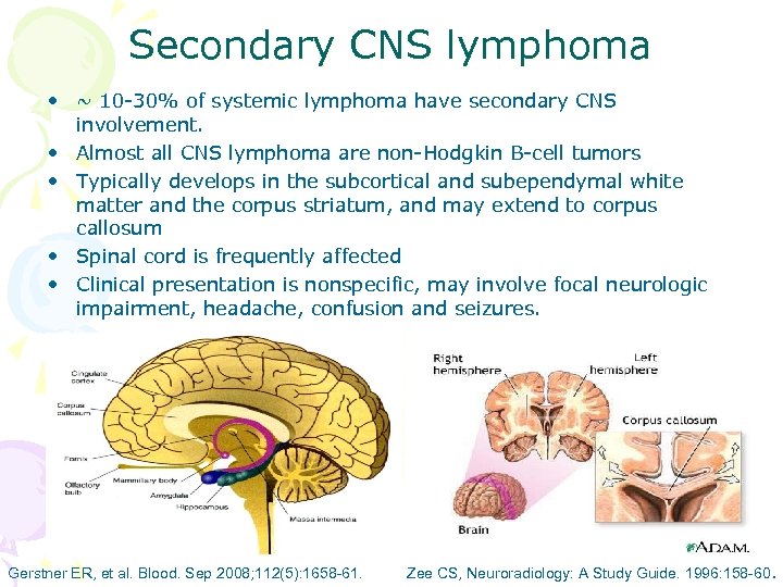 Secondary CNS lymphoma • ~ 10 -30% of systemic lymphoma have secondary CNS involvement.