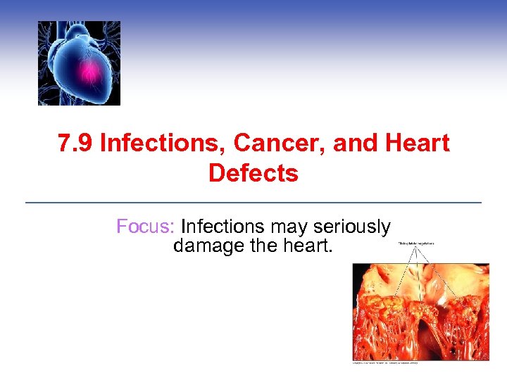 7. 9 Infections, Cancer, and Heart Defects Focus: Infections may seriously damage the heart.