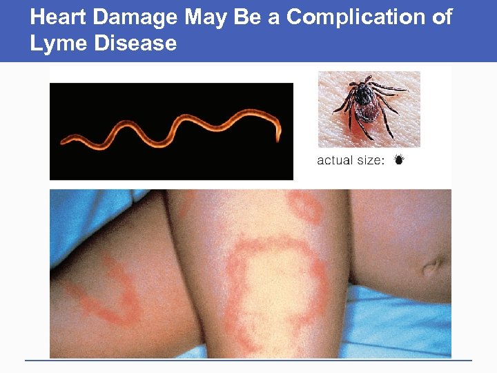 Heart Damage May Be a Complication of Lyme Disease 