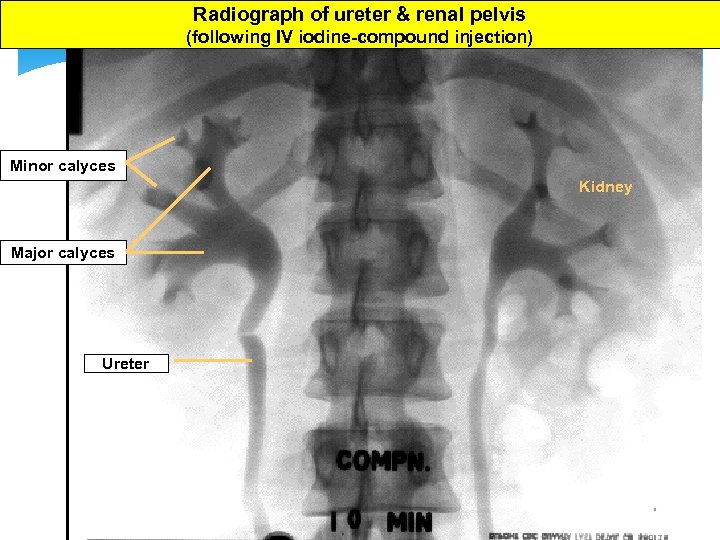 Radiograph of ureter & renal pelvis (following IV iodine-compound injection) Minor calyces Kidney Major