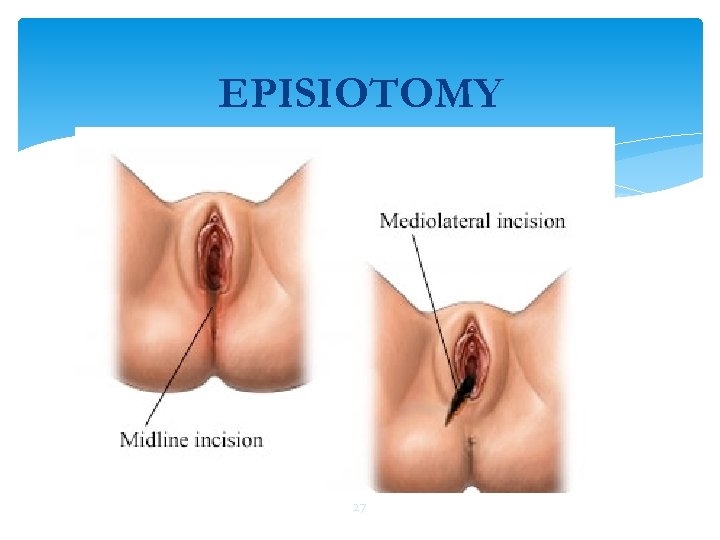 EPISIOTOMY 27 