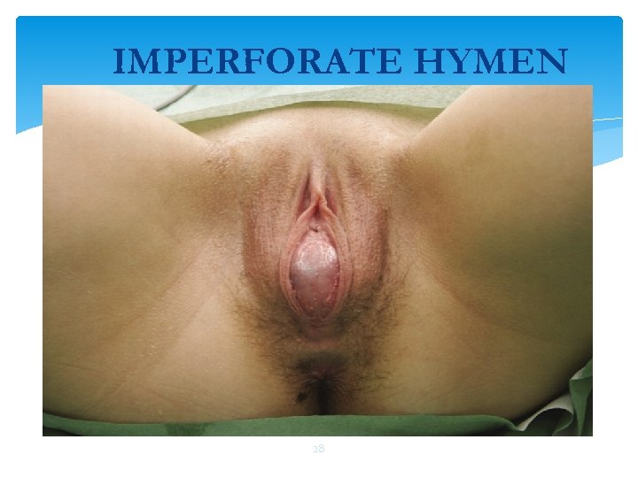 IMPERFORATE HYMEN 28 