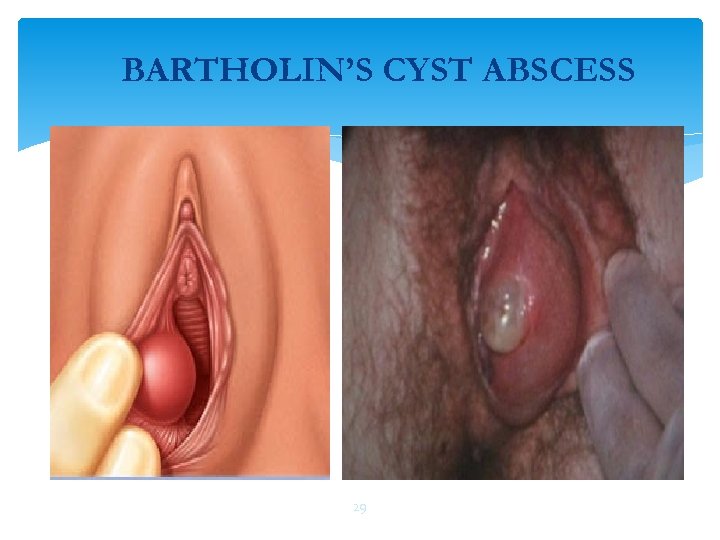 BARTHOLIN’S CYST ABSCESS 29 