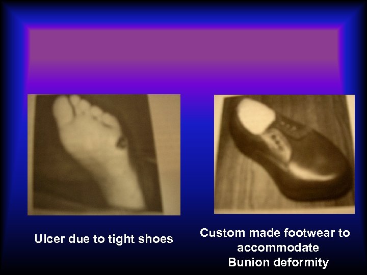 Ulcer due to tight shoes Custom made footwear to accommodate Bunion deformity 