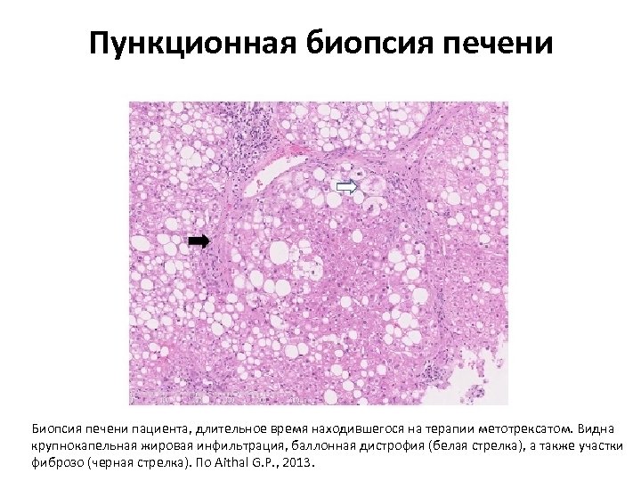 Биопсия печени при циррозе заключение. Гистологические исследование биоптата печени. Пункционная биопсия печени.