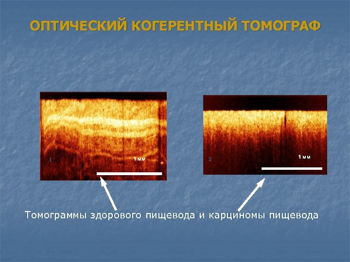 ОПТИЧЕСКИЙ КОГЕРЕНТНЫЙ ТОМОГРАФ 1 1 мм 2 1 мм Томограммы здорового пищевода и карциномы