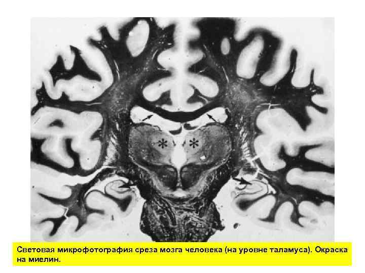 Световая микрофотография среза мозга человека (на уровне таламуса). Окраска на миелин. 
