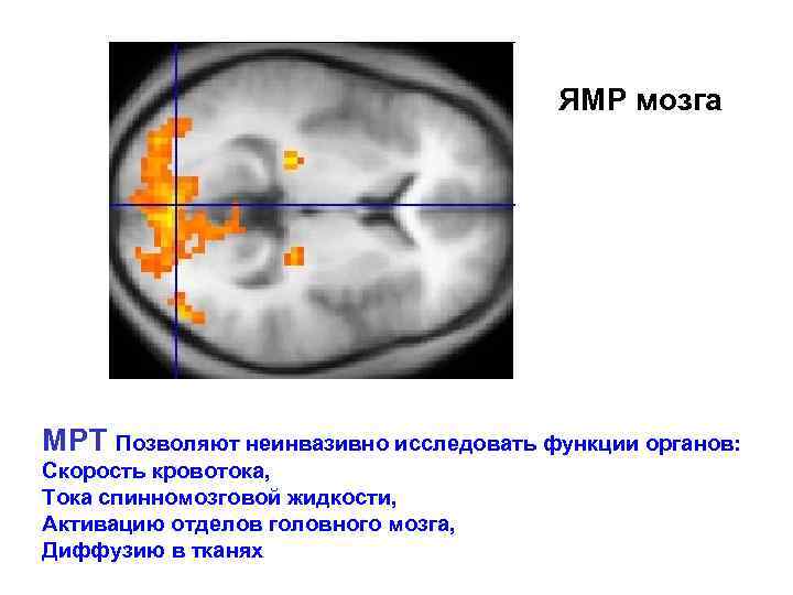 ЯМР мозга МРТ Позволяют неинвазивно исследовать функции органов: Скорость кровотока, Тока спинномозговой жидкости, Активацию