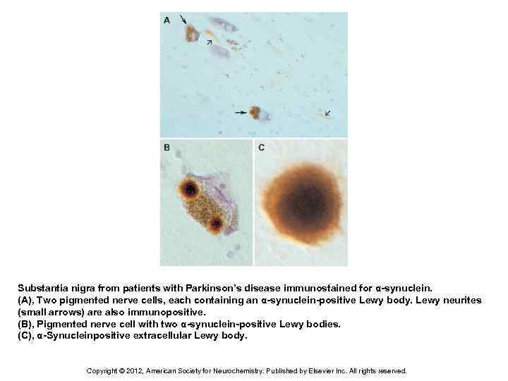 Substantia nigra from patients with Parkinson’s disease immunostained for α-synuclein. (A), Two pigmented nerve