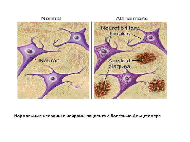 Нормальные нейроны и нейроны пациента с болезнью Альцгеймера 
