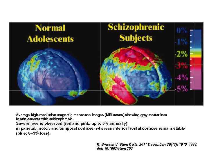 Average high-resolution magnetic resonance images (MRI scans) showing gray matter loss in adolescents with